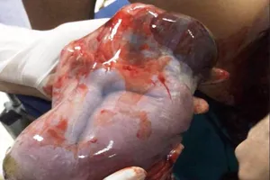 Kinh ngạc em bé xứ Nghệ ra đời trong bọc ối còn nguyên