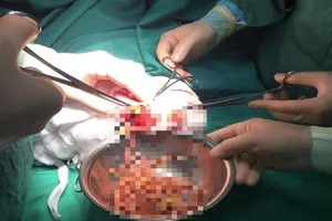 Kinh hoàng ổ giun lớn gây tắc ruột bé 3 tuổi