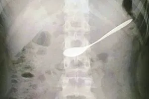 Cứu cô gái 20 tuổi đi uống cà phê nuốt chiếc thìa vào bụng 