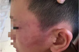 Giám định thương tật cháu bé bị mẹ kế tát bầm tím