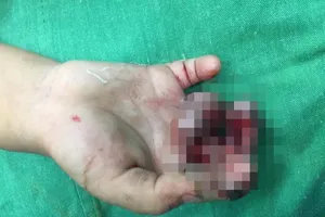 Nghịch dại, bé 4 tuổi cho tay vào máy ép nước mía