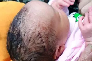 Mổ đẻ, bác sĩ đụng dao làm rách da đầu bé sơ sinh