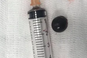 Nghệ An: Gắp hạt nhãn trong phổi bé 12 tuổi ra ngoài