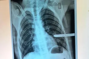 Cứu bé trai 13 tuổi bị thanh sắt dài đâm thủng phổi