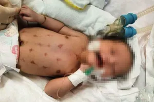 Mời thầy lang đến nhà lễ đẹn khiến bé sơ sinh nguy kịch