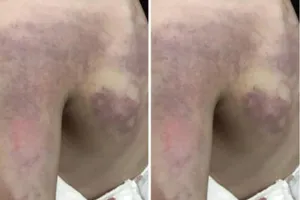 Tạm đình chỉ công tác cô giáo đánh học sinh bầm vai