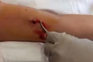 Chiếc que tránh thai ‘đi lạc’ trong bắp tay người phụ nữ 31 tuổi