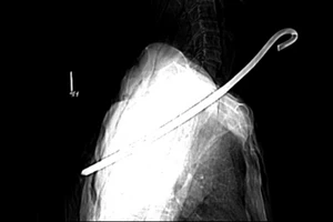 Cụ ông bị cây sắt đâm vào cổ, xuyên xuống phổi