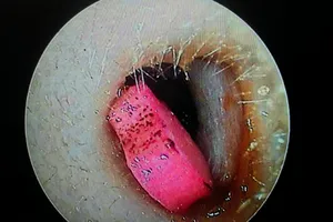 Cứu học sinh bị sốt vì có cục tẩy nằm trong tai