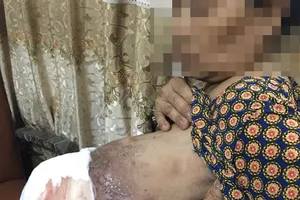 Đắp thuốc Nam, nữ bệnh nhân bị hoại tử vú