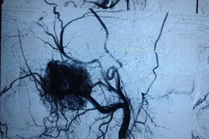 Khối u mũi cực hiếm chỉ gặp ở nam giới tuổi dậy thì