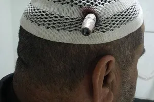 Bị đầu đạn loại 12 ly 7 'vô chủ' cắm vào đầu!