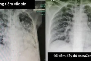 Chuyên gia: Cần rút ngắn khoảng cách giữa 2 mũi vaccine Astrazeneca ở 'vùng đỏ'