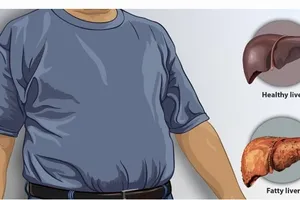 Không chỉ rượu, những thực phẩm này có thể dẫn đến bệnh gan nhiễm mỡ