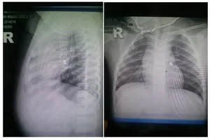 Gắp thành công dị vật kim loại trong khí quản bé 20 tháng tuổi