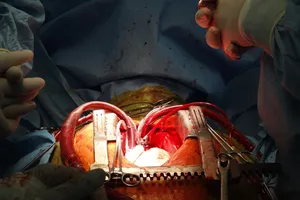 Ghép tim nhân tạo đầu tiên tại Việt Nam