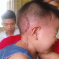 Trưng cầu giám định bé 14 tháng tuổi bị con nợ của bố chém vào đầu