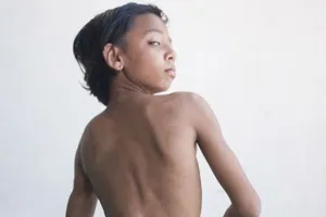 Cậu bé Ấn Độ có đuôi được coi như thánh thần