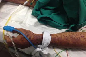 Sốc: Bị hoại tử mặt, tử vong vì ăn tiết canh lợn dính liên cầu khuẩn 