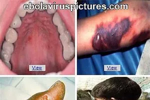 Bộ Y tế hướng dẫn các biện pháp phòng tránh dịch Ebola