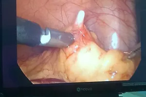 Mổ nội soi lấy vòng tránh thai lạc vào ổ bụng