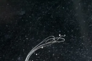 Phát hiện cước câu cá trong… niệu đạo thiếu niên