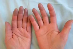 8 nguyên nhân khiến tay chân bạn lúc nào cũng lạnh