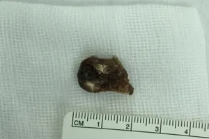 Hóc xương cá tám tháng mà không biết