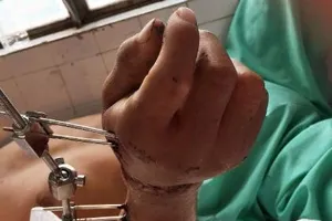 Nối thành công bàn tay gần bị đứt lìa do máy trộn bê tông 