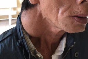 Do nghèo nên 20 năm mới đi mổ khối u