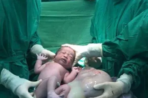 Kỳ diệu bé gái song sinh chào đời vẫn trong bọc ối