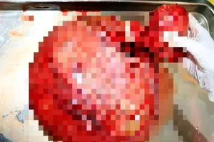 Tự uống thuốc, để khối u xơ nặng tới 4kg