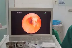 Ho suốt ba năm trời mới phát hiện bị mắc xương cá