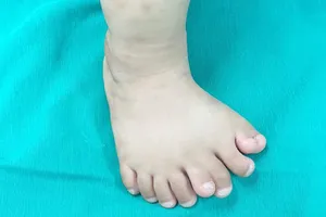 Hy hữu: Bé trai Thanh Hóa có 9 ngón trên 1 bàn chân 