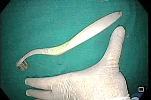 Trượt ngã khi đánh răng, nữ sinh nuốt bàn chải dài 20cm vào bụng