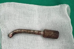  Phẫu thuật rút mũi khoan đá đâm xuyên hốc mũi bệnh nhân