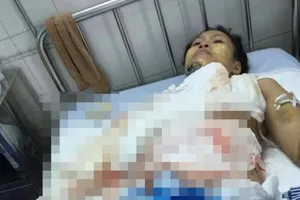 Nhân viên spa bị bỏng nặng do cồn phát nổ