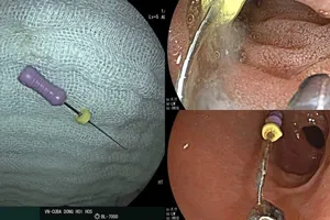 Quảng Bình: Cứu bé gái 5 tuổi nuốt kim nha khoa vào bụng