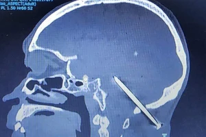 Bị cây đinh đâm vào não suốt 1 năm mà không biết
