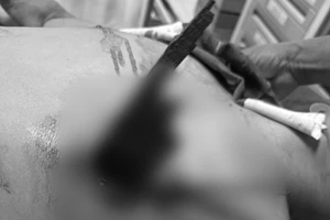 Đi xe máy tông vào hàng rào, nam thanh niên bị thanh gỗ đâm xuyên ngực