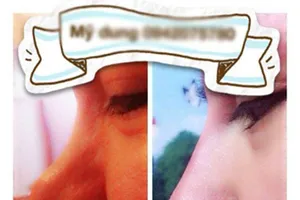 Hoảng hồn tiêm “thần dược” làm đẹp chui tại Hà Nội