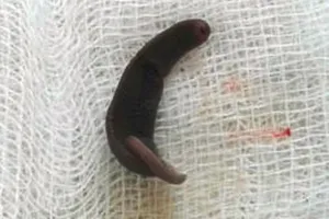 Con vắt dài 4cm sống hơn 10 ngày trong mũi bệnh nhi ở Hà Giang