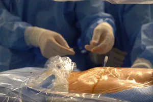 Tán sỏi đường mật qua da bằng laser - bước tiến thay thế mổ mở