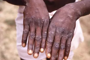 Các tổn thương trên da do đậu mùa khỉ gây ra. Ảnh: AFP