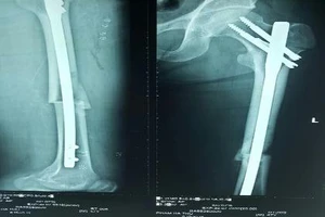 Cứu bệnh nhân gãy 2 chân do cây đè