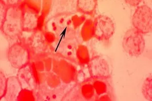 Thêm trường hợp mắc bệnh não mô cầu ở TP.HCM