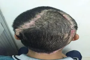 Cấy tóc cho bệnh nhân bị… lộ xương sọ