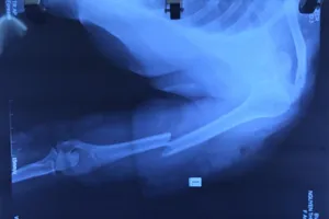 Cứu bàn tay bị gãy, lột toàn bộ da