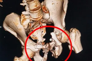 Cứu sống 2 bệnh nhân nhờ báo động đỏ nội viện