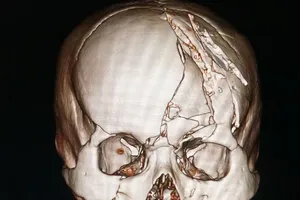 Cứu sống nạn nhân sọ vỡ nát nhiều mảnh